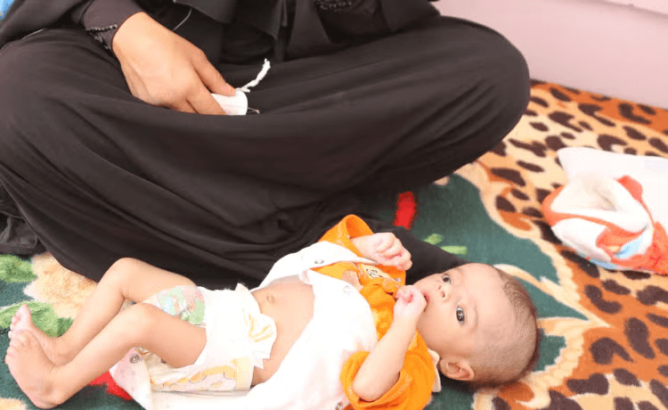 Postpartum mother in Yemen holding her baby, who is receiving treatment for malnutrition